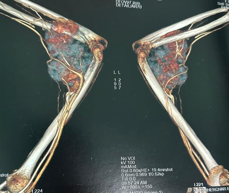 Image illustrant le cancer du coude