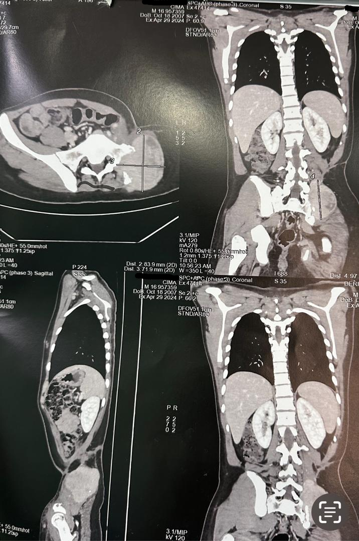 Image illustrant le cancer du bassin