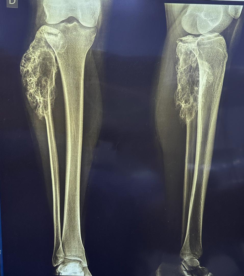 Image illustrant le cancer du péroné