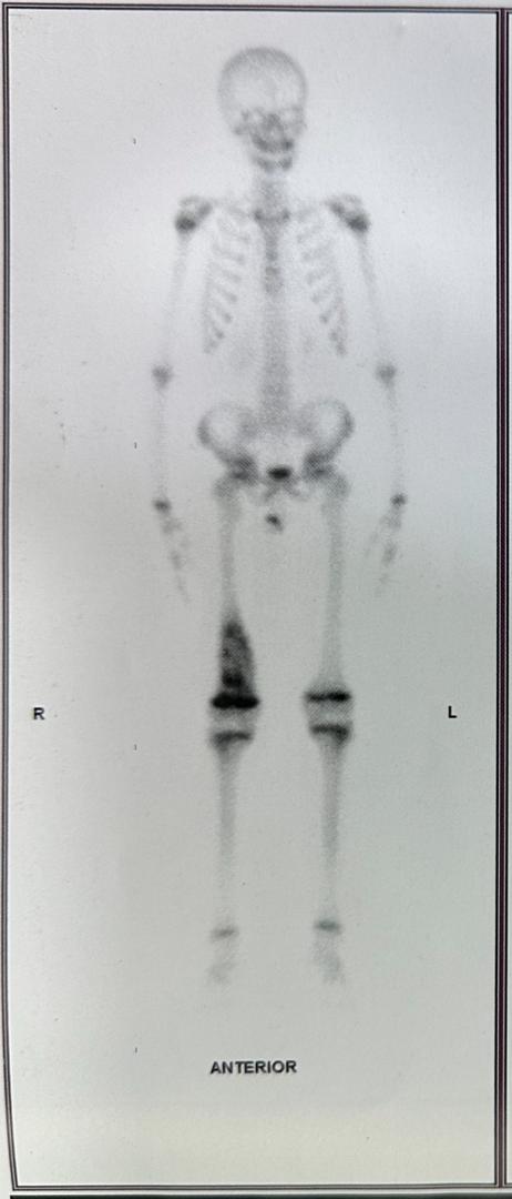 Image illustrant le cancer des os