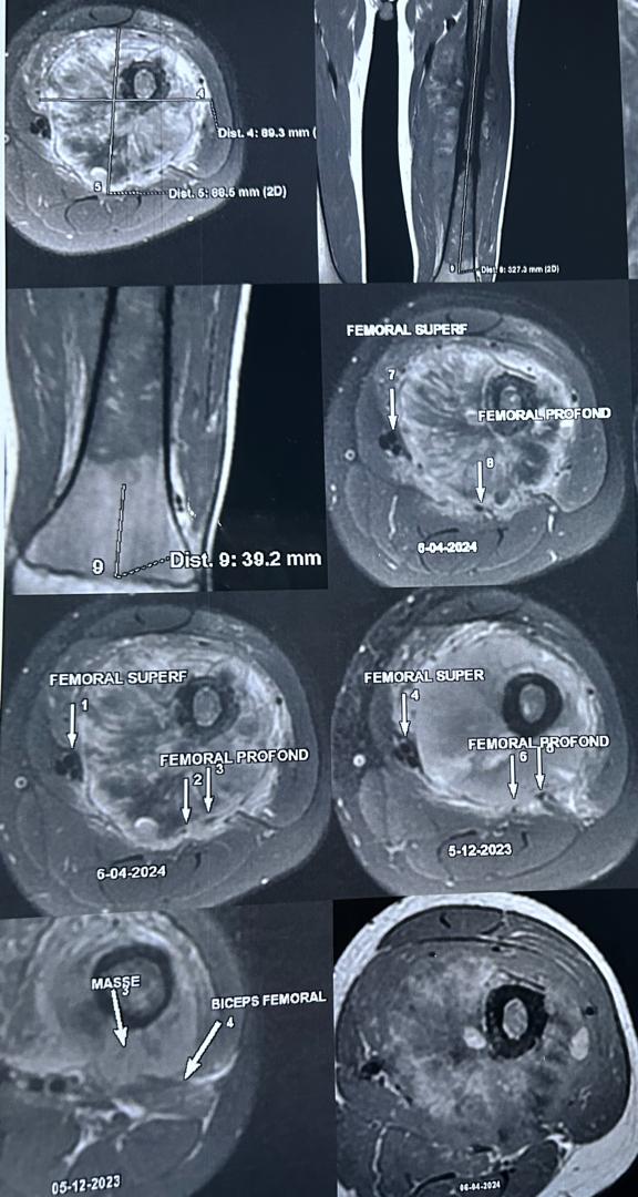 Image illustrant le cancer du genou